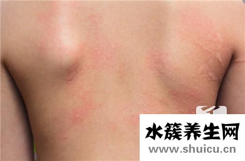 压力性紫癜