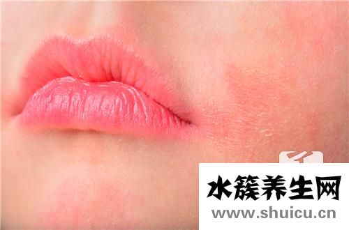感染性皮炎