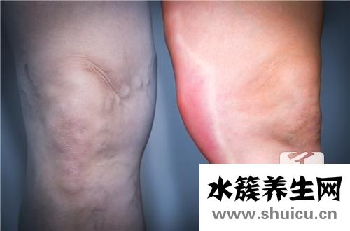 滑膜炎什么症状