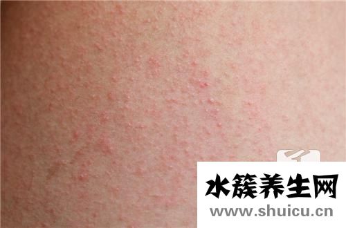 风疹块治疗方法