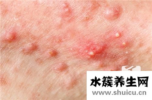痘痘很大很硬很肿是什么原因？痘痘引起的大硬块