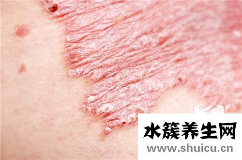 头皮癣怎么治才能去根 头皮癣有好的办法快速去根吗？