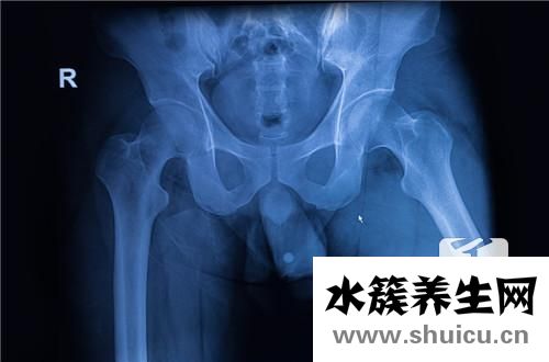 致密性骶髂关节炎