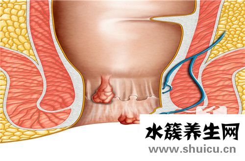 肛门边上鼓出来个肉球怎么回事呢?