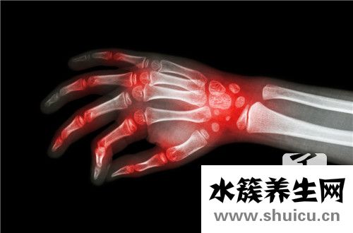 痛风检查什么指标的呢？痛风血液检查哪些指标