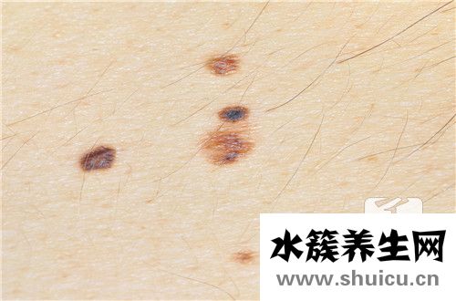 点痣留疤去除