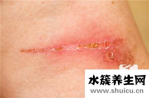 刀疤去除