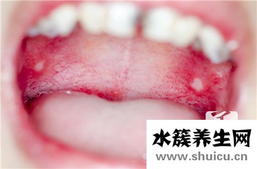 口腔溃烂