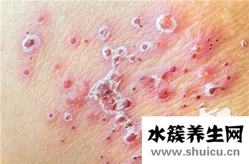 荨麻疹应该注意些什么