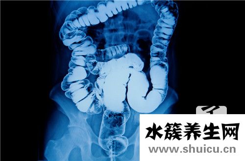 乙状结肠炎