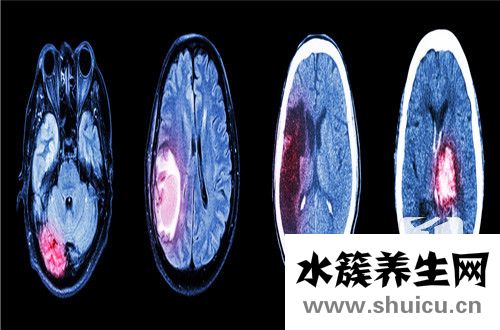 脑脊液蛋白高
