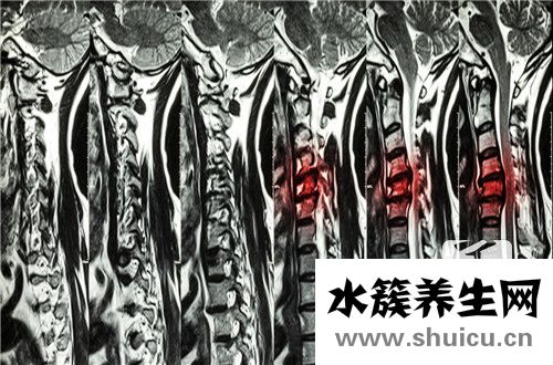 脊柱侧弯办