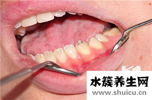 牙根管前要消炎一周吗？牙根发炎,吃了一周的消炎药