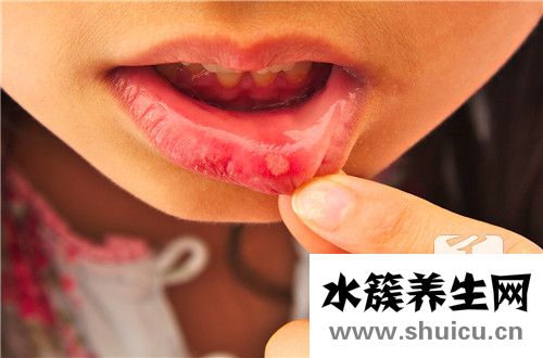 口腔常见遗传性疾病是什么？常见口腔粘膜病有哪些？