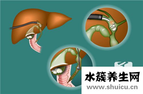 尿管结石