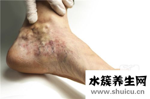 下肢血管彩超