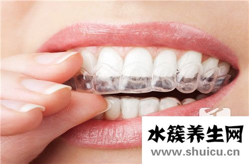 钢丝牙齿矫正