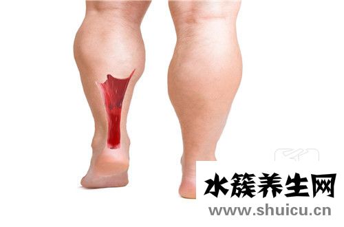 跟腱二断