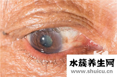 眼睛囊肿