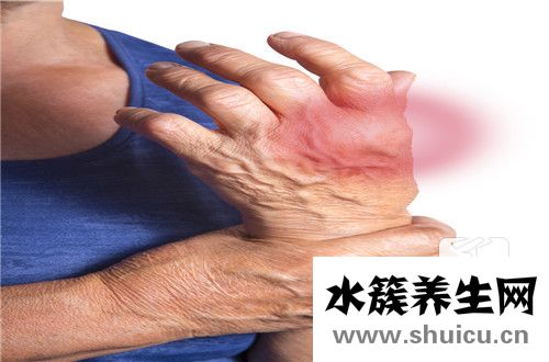 治风湿关节炎最好药