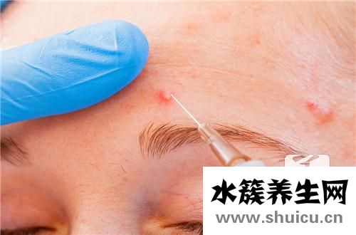 麻疹皮肤病