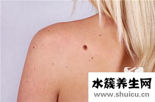 胎记激光治疗