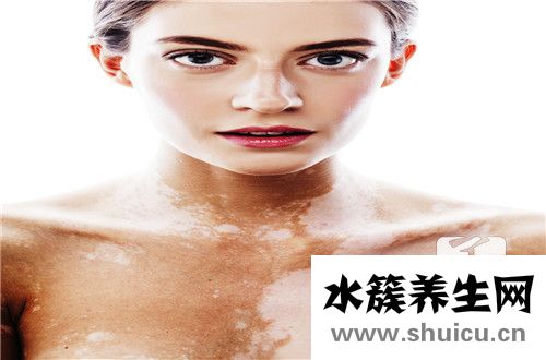 缺锌脸上白斑同