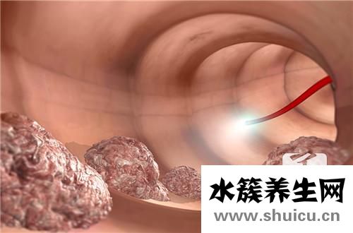 肛门周围溃疡是什么病 肛门周围有一溃疡，该用什么药