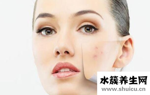 怎么消除痘印