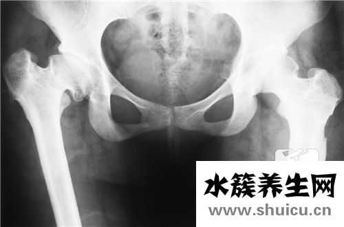 髂骨疼