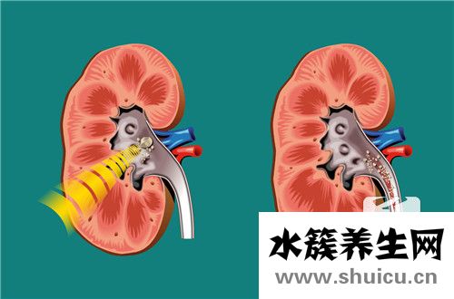 输尿管结石挂什么科室 肾结石挂什么科？