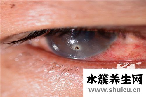眼睛球结膜充血怎么办？眼睛结膜充血