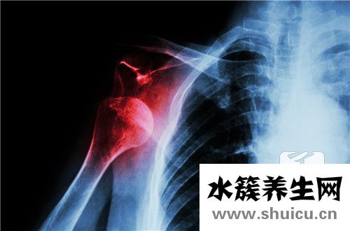 肩周炎诊断与鉴别诊断 肩周炎的鉴别诊断