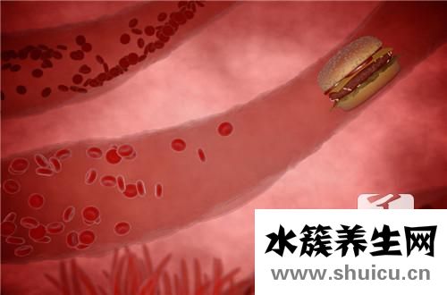 动脉硬化斑块