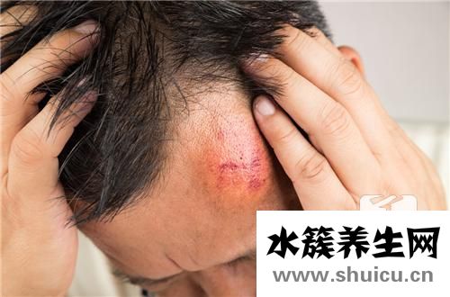 黏液囊肿
