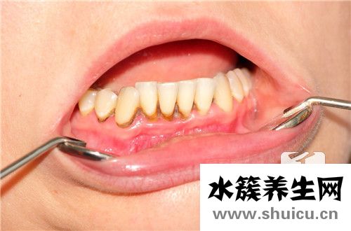 拔出智齿
