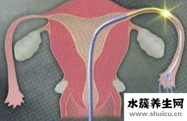 通水手术是什么？输卵管通水怎么做？