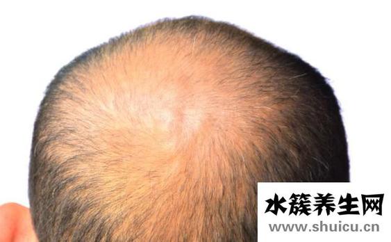 男性头发秃顶了怎么治疗？6个治疗秃顶的方法
