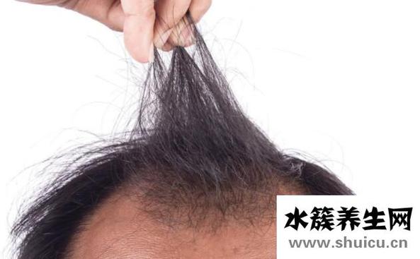 头发秃顶怎么治疗