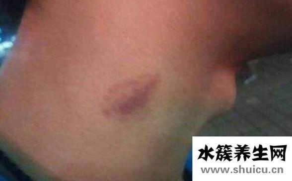 吻痕怎么消除