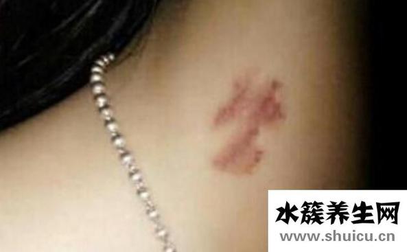 吻痕怎么消除