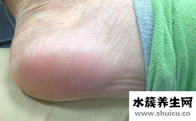脚后跟疼