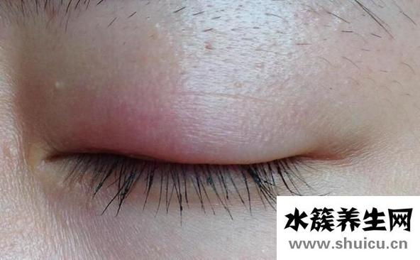什么原因会导致上眼皮肿？导致上眼皮肿的5个原因