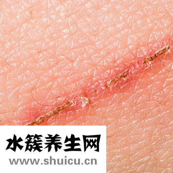 选择适合我自己的去除疤痕方法，怎样祛疤生活妙招