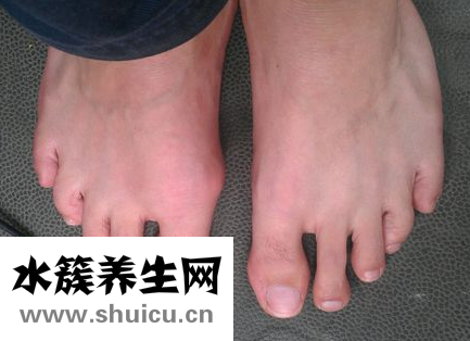 痛风发作时如何快速解决？教你如何止痛