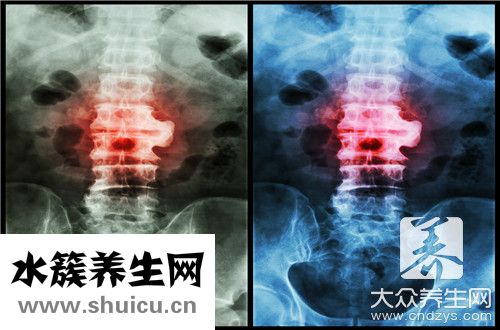 脊柱炎治疗