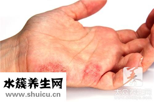 手指长湿疹