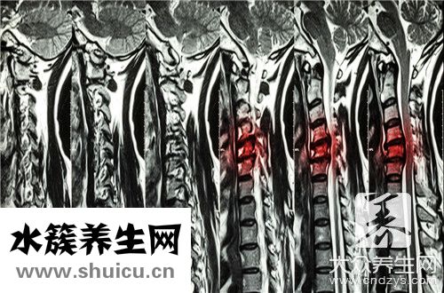 椎弓峡部裂