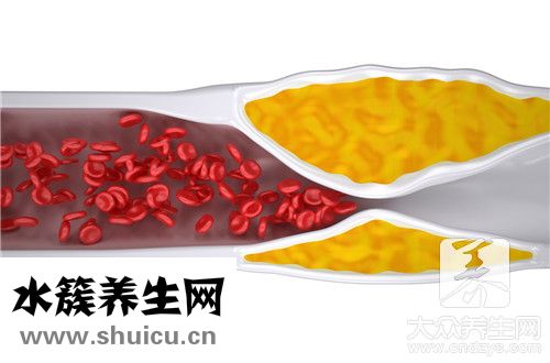 心血管钙化