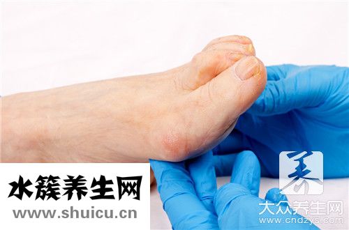 跖疣冷冻